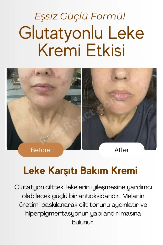 Cilt Beyazlatıcı, Leke Kremi, Kararma, Akne, Güneş Lekeleri, Glutatyonlu Beyazlatıcı Leke Krem 50ml