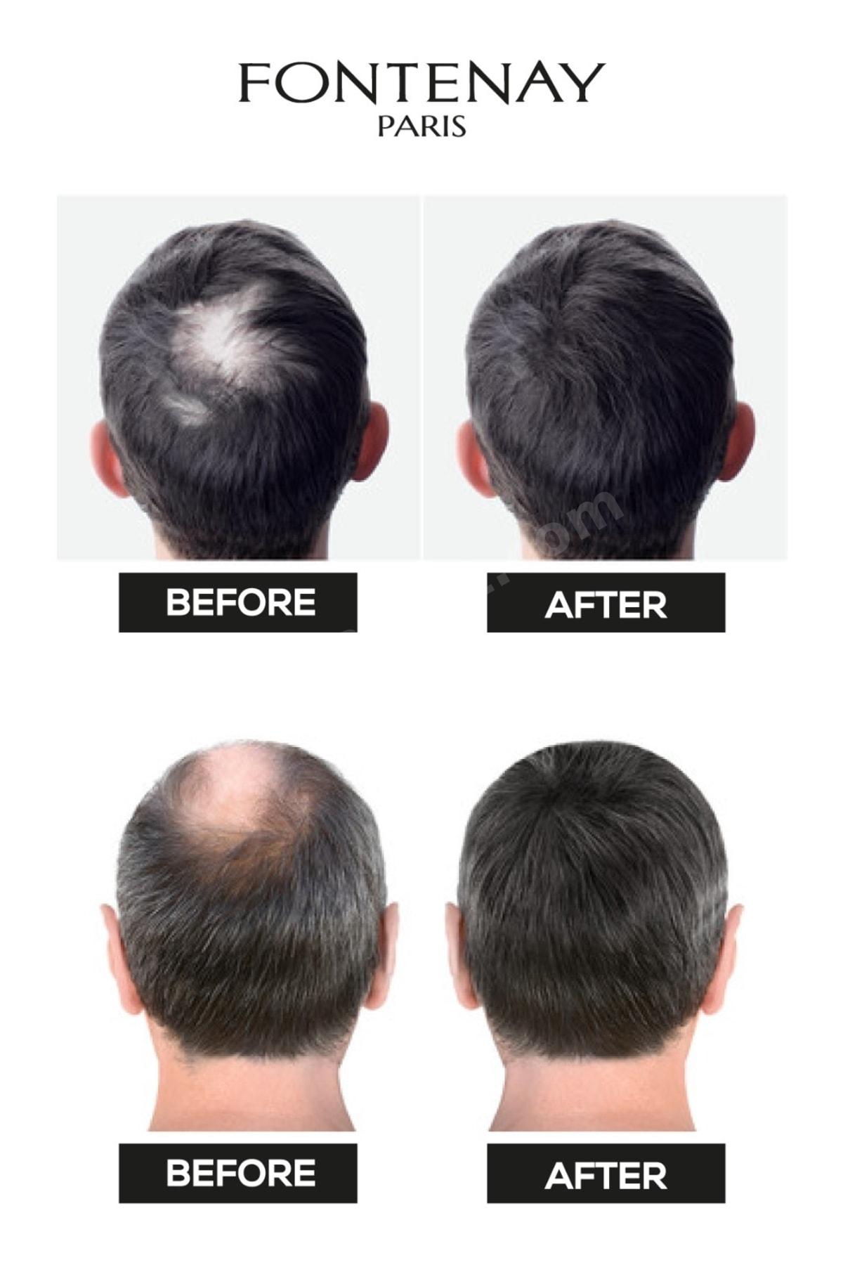 Saç Dolgunlaştırıcı Keratin Fibers Siyah Topik Saç Tozu 50gr