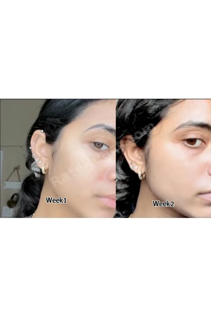 Yüksek Asit Oranlı Kojic Asit Sabunu (Zerdeçal Ve Kojik Asit) Leke Karşıtı Kojik Asit Sabunu