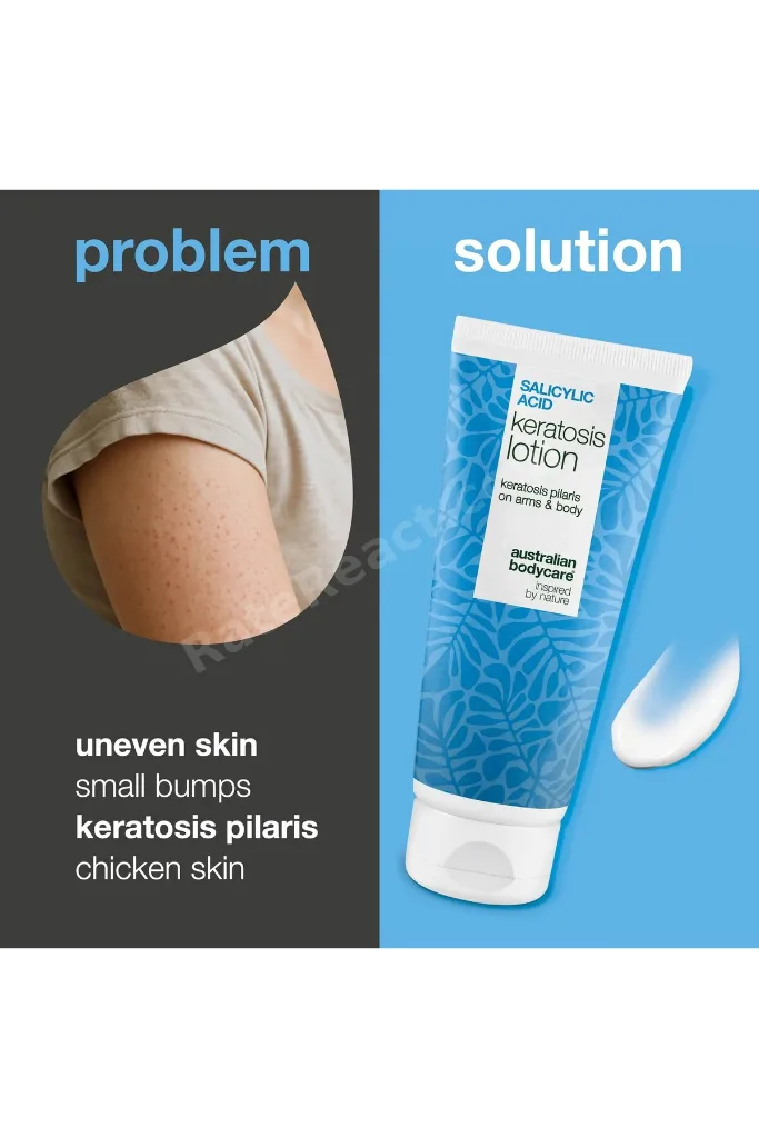 SALICYLIC ACID KERATOSIS LOTION 200ML