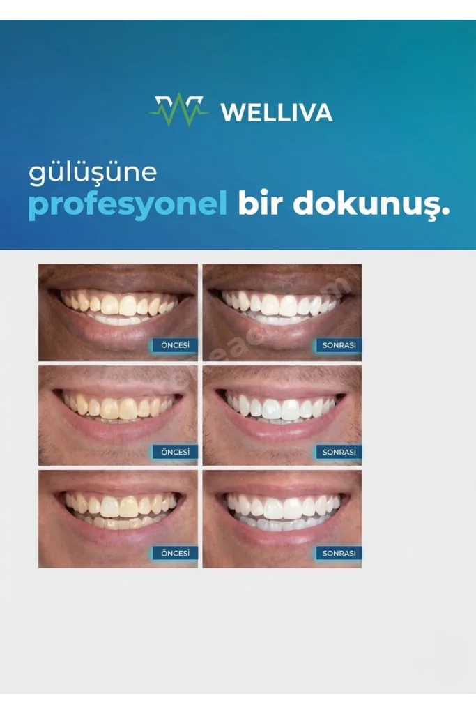 Diş Beyazlatma Bandı 28’li – Anında Etkili Beyazlatma (Teeth Whitening Strip)